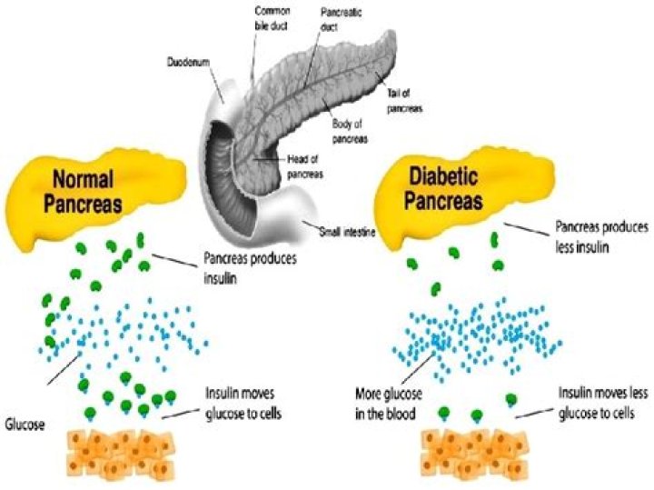 Can fatty pancreas be reversed