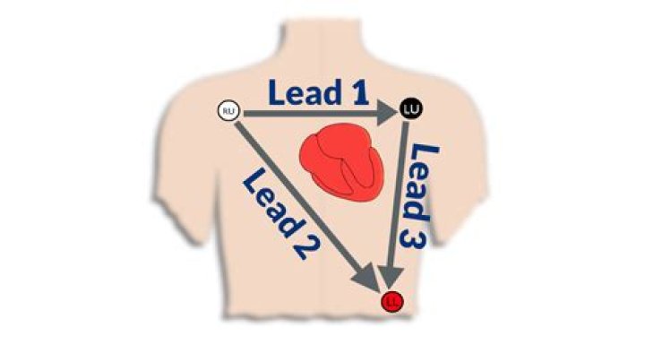 Can lead placement affect ECG