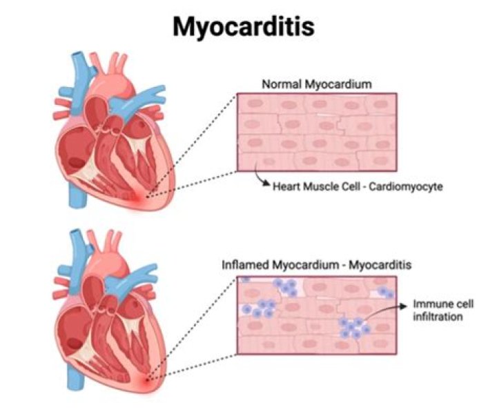 Can pericarditis lead to myocarditis