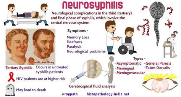 Can syphilis cause nerve pain
