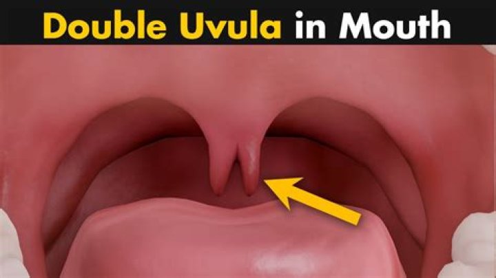 Can you have a double uvula