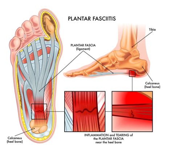 Can your fascia hurt