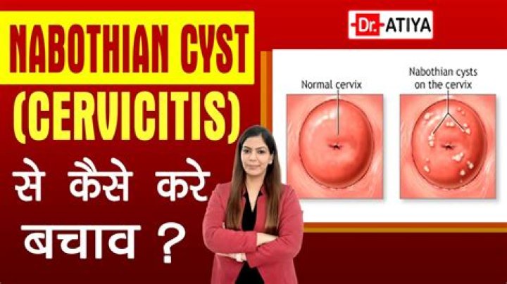 Cest quoi un kyste de Naboth