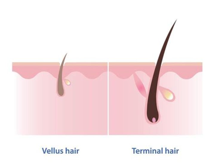 Does Vellus hair turn into terminal hair