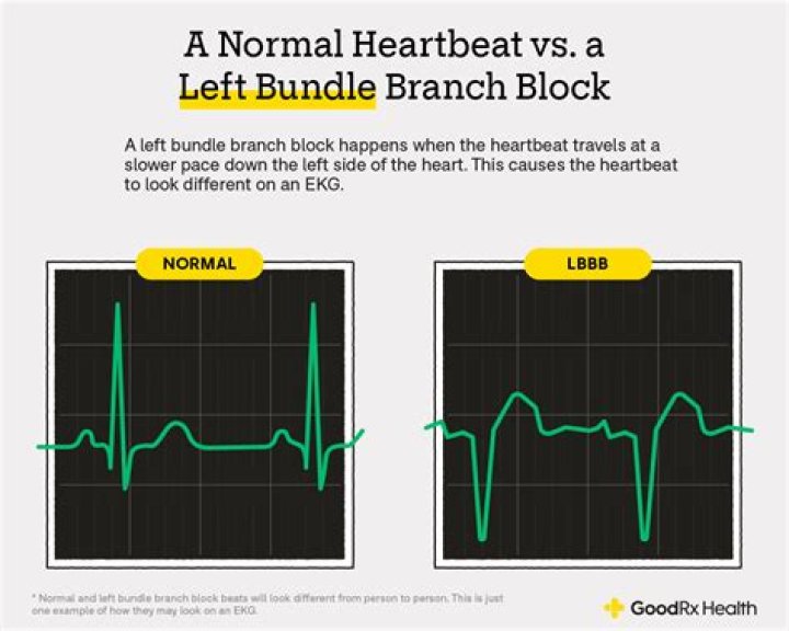 How do you know if you have a left bundle branch block