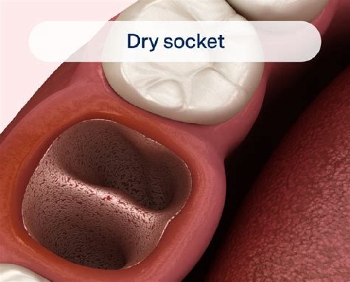 How do you make RTV dry faster