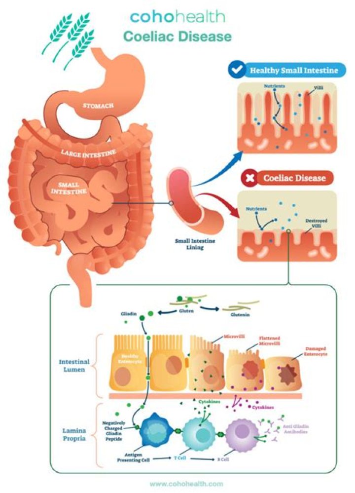 How do you manage Coeliac disease