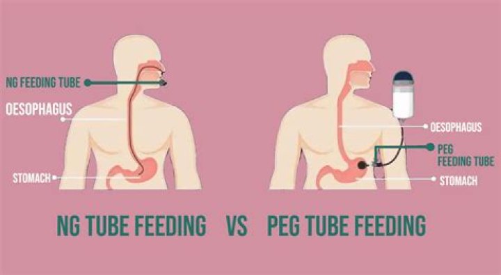 How much does feeding tube food cost