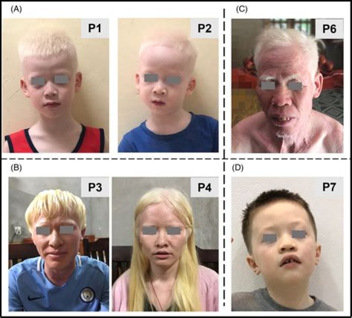 Is albinism a phenotype