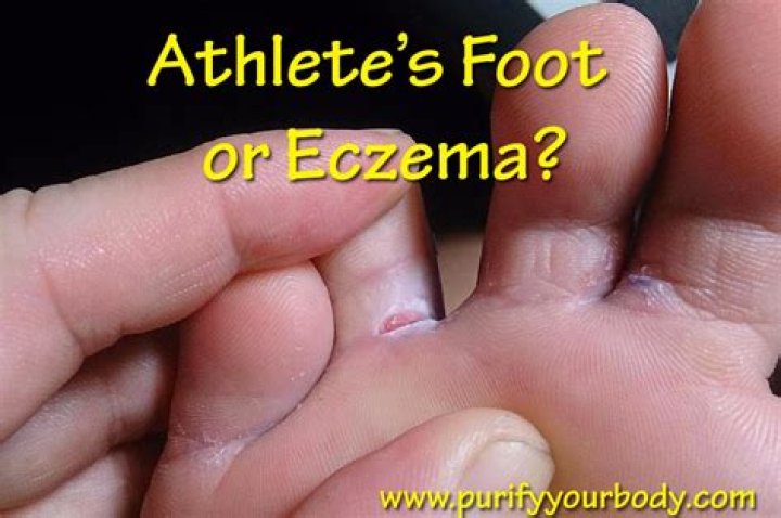 Is it athletes foot or eczema