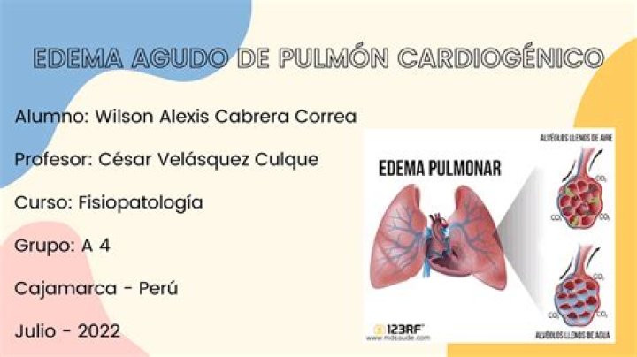 ¿Qué causa el edema agudo de pulmon
