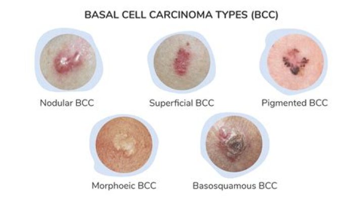 What are the different types of basal cell carcinoma