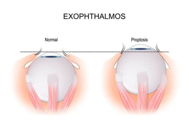 What causes Exophthalmos