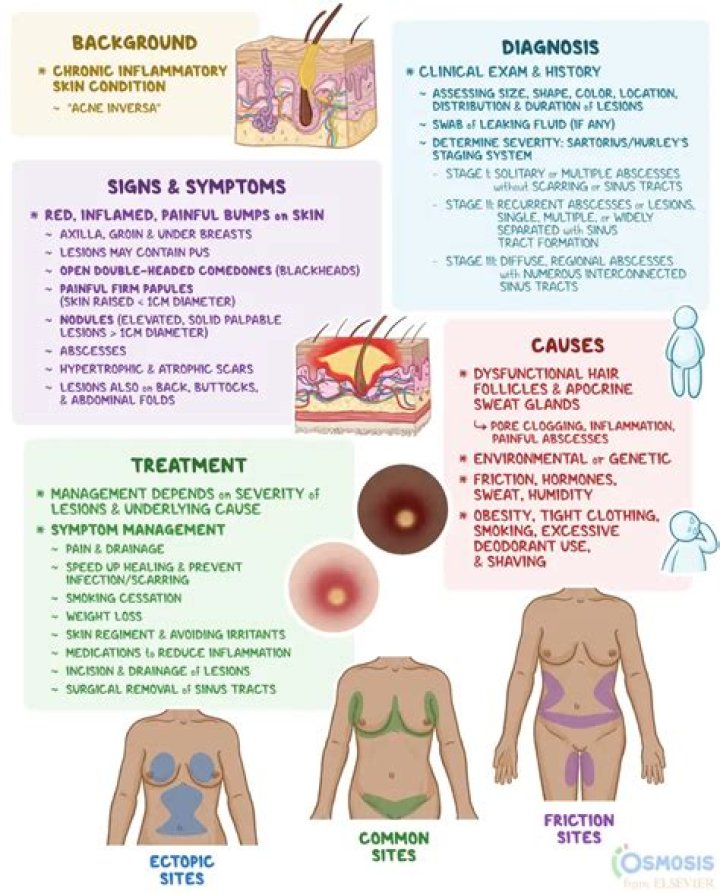 What causes hidradenitis flare ups