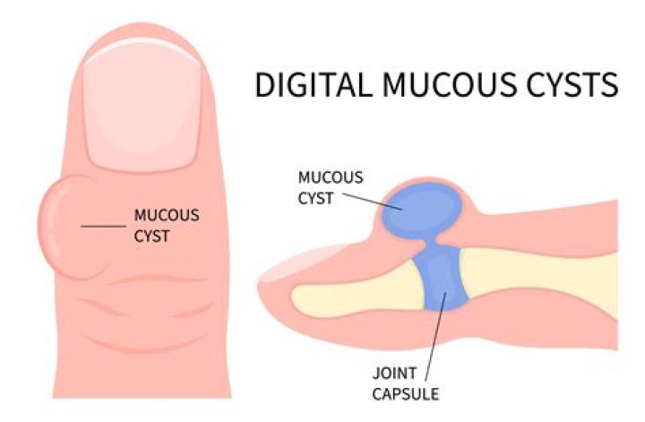 What causes mucous cyst