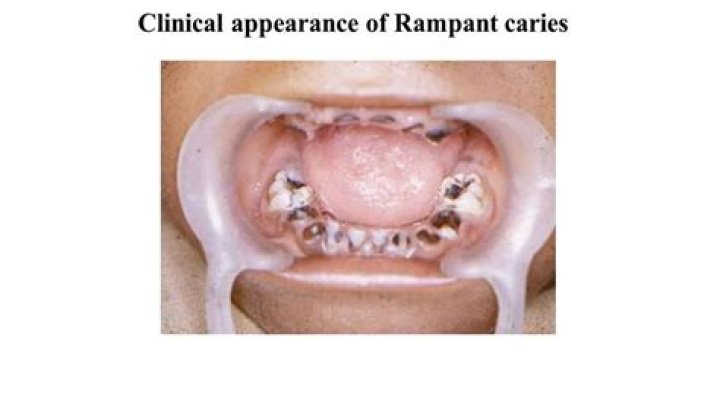 What causes rampant caries