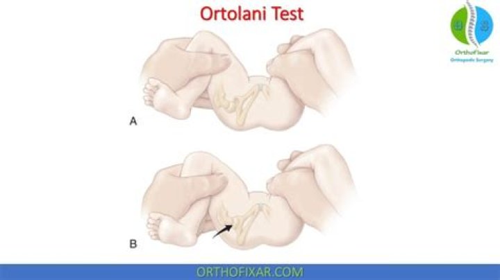 What does a positive Ortolani test mean