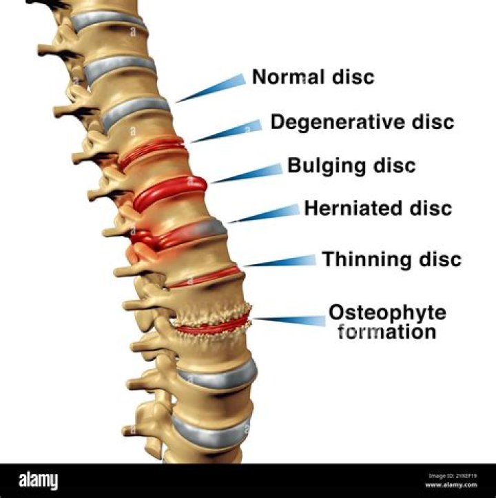 What does disc Osteophyte complex mean