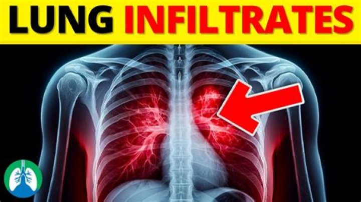 What is a Lymphohistiocytic infiltrate