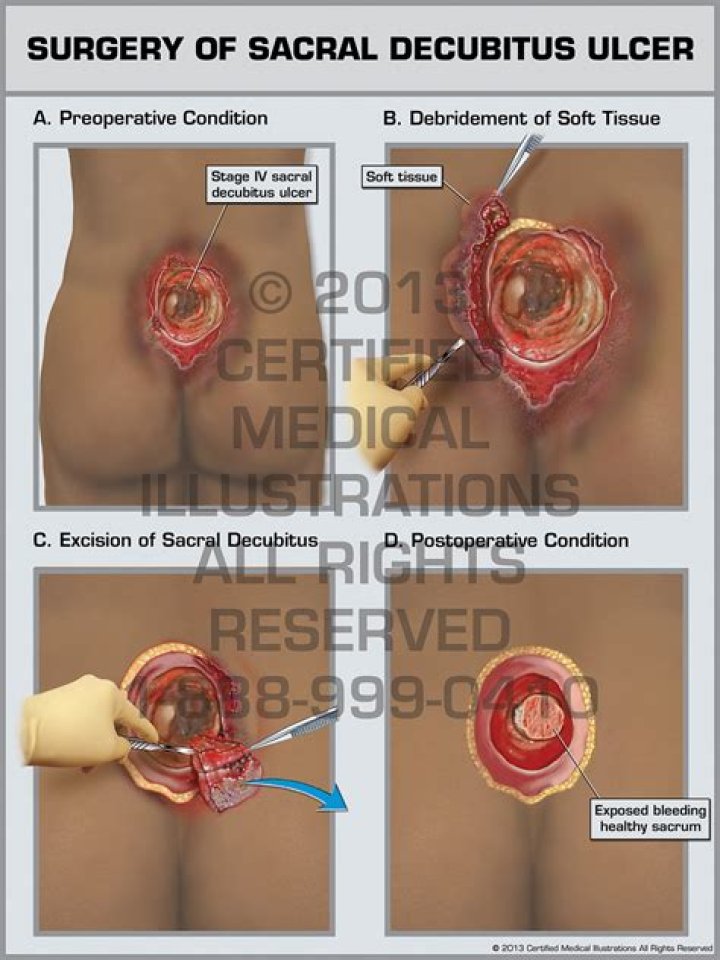 What is a sacral decubitus ulcer