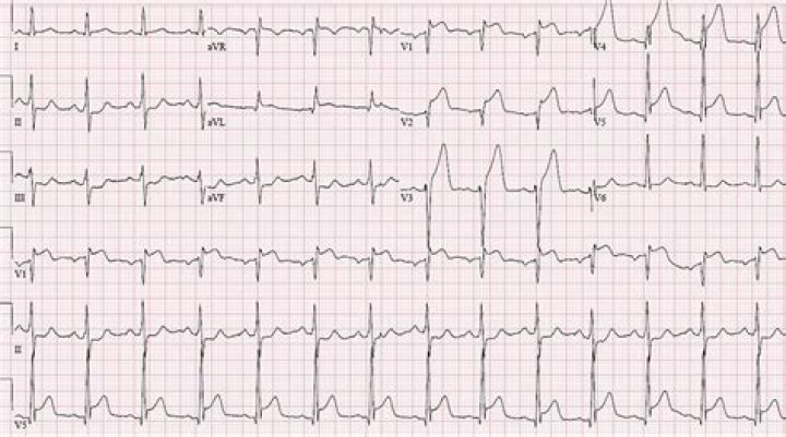 What is a stemi procedure