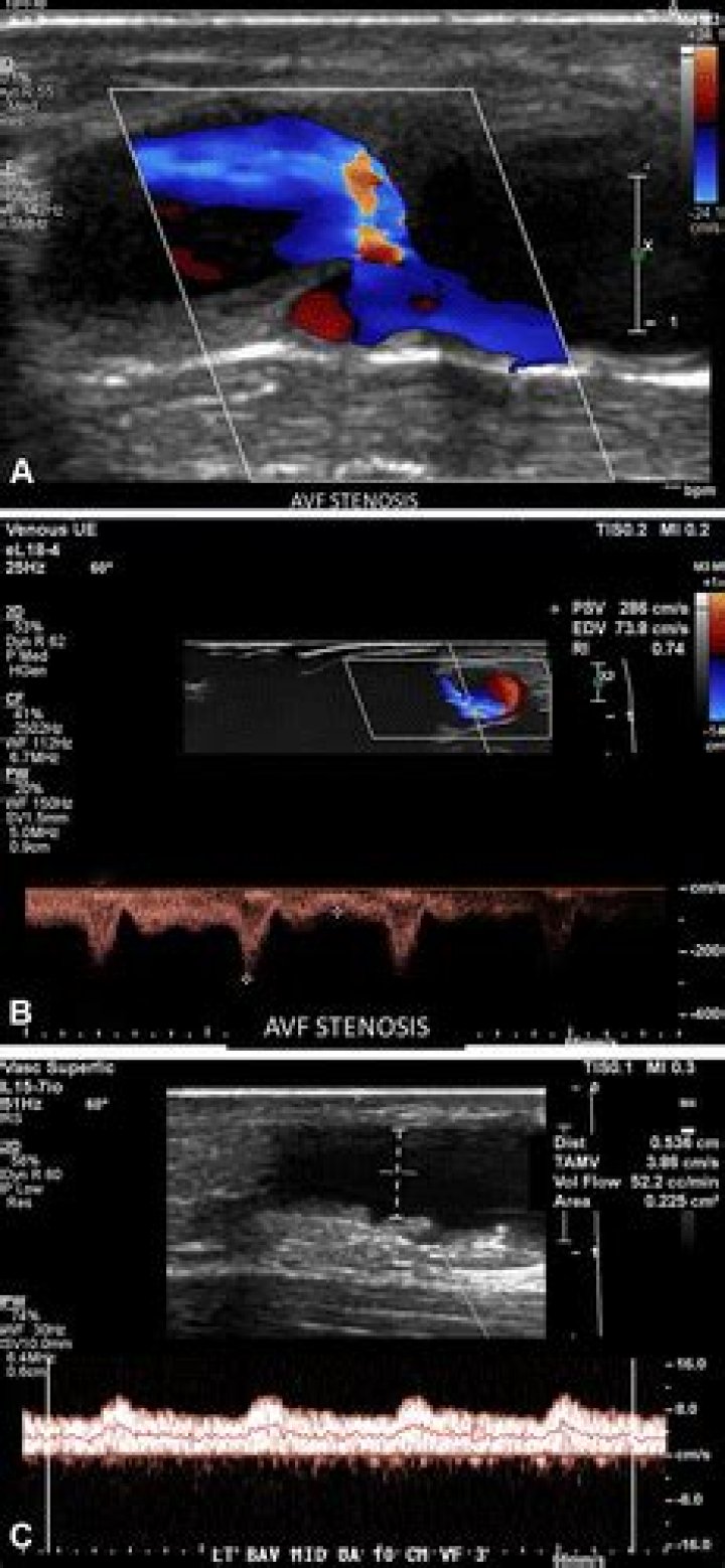 What is Juxta anastomotic stenosis