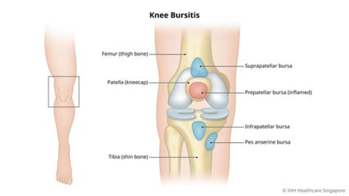What is Pretibial bursitis