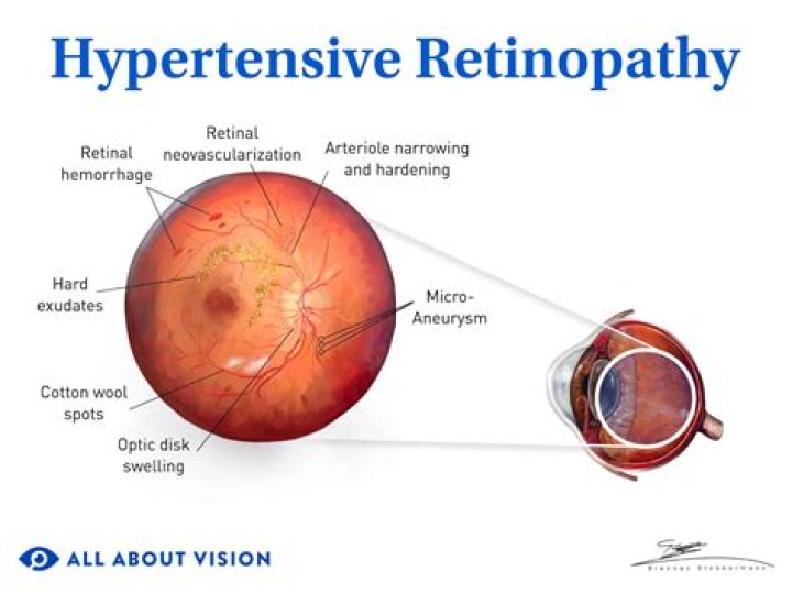 What is seen in hypertensive retinopathy