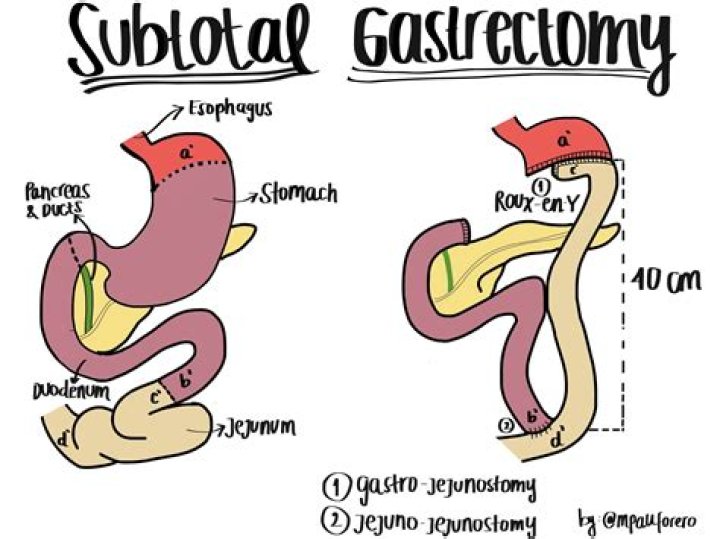 What is subtotal gastrectomy