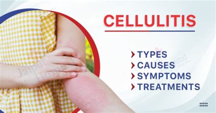 What to put on cellulitis to stop itching