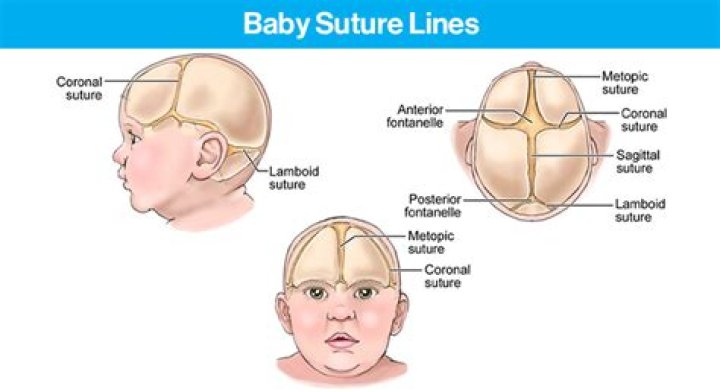 Which suture is typically found only in newborns