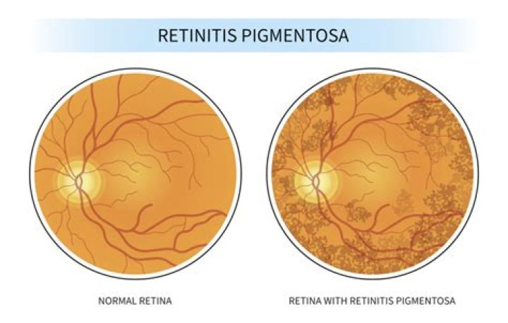 Who is most likely to get retinitis pigmentosa